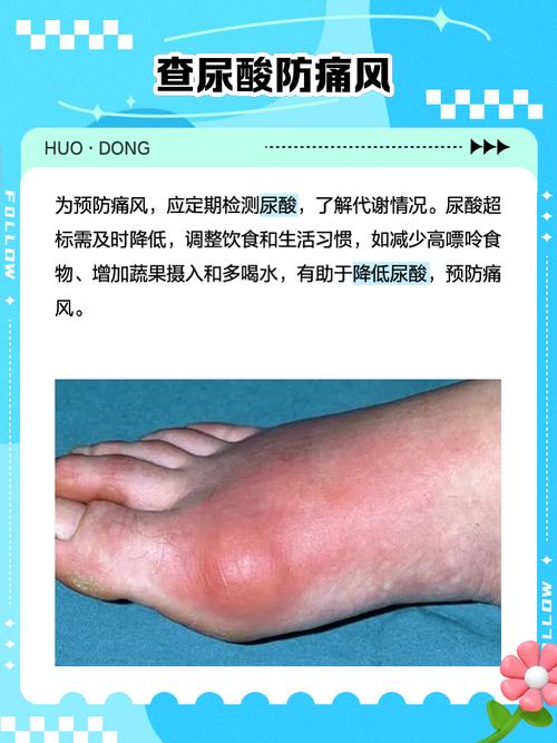 12种尿酸自测方法:12种尿酸自测方法视频