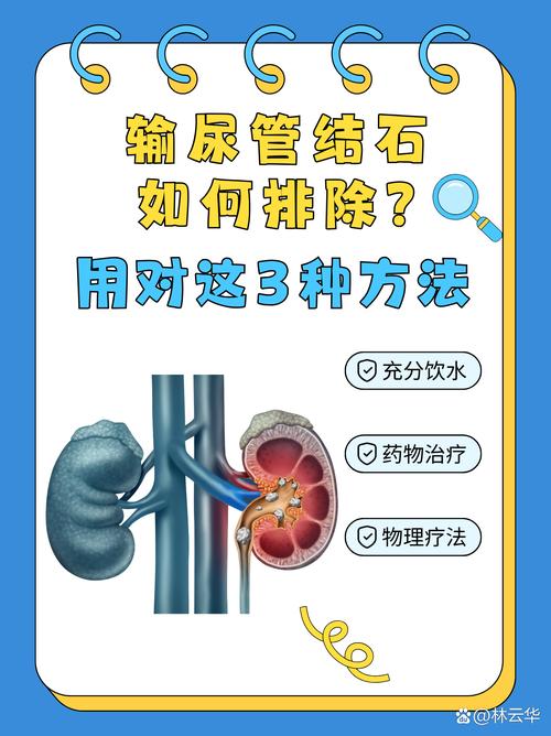 什么是尿酸性结石:尿酸性结石怎么治疗